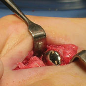 Interphalangeal foot joint implant HemiCAP DF®
