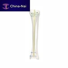 Tibial intramedullary nail SJGKproximal fixationdistal fixationmetallic
