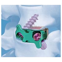 Cervical interbody fusion cage G-58020anteriorPEEK