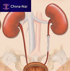 Ureteral stent Memokath051nitinol