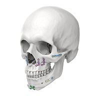Genioplasty compression plate lockingmetallic