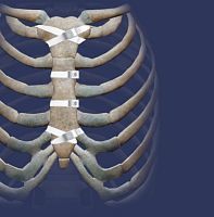 Sternal closure bone cerclage wiring Ortholox® UHMWPEmultifilament polymer