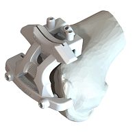 Knee prosthesis resection guide PERFETTO
