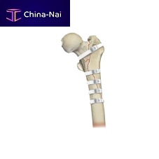 Hip revision surgery bone cerclage wiring Ortholox® UHMWPEmultifilament polymer