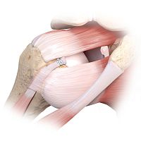 Rotator cuff suture anchor Tacknon-absorbable