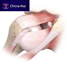 Rotator cuff suture anchor Tacknon-absorbable