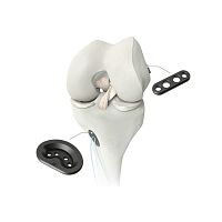 Anterior cruciate ligament ligament prosthesis M-ARSsynthetic