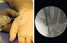 Metacarpophalangeal joint arthrodesis screw REDUCThand phalangeheadlessmetallic