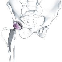 Minimally invasive hip prosthesis Metha® cementless