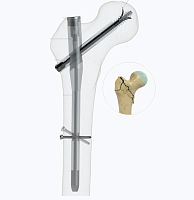 Femoral intramedullary nail proximal fixationrightleft