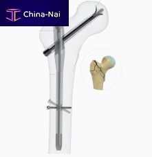 Femoral intramedullary nail proximal fixationrightleft