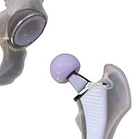 Primary hip prosthesis Cordera cementless