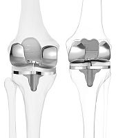 Total knee prosthesis iTotal® CRsliding, cruciate-retainingcemented