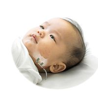 Mandibular distractor internalpediatric