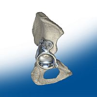 Revision acetabular prosthesis cemented