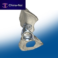 Revision acetabular prosthesis cemented