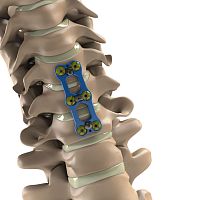 Cervical arthrodesis plate T-6Al-4V ELI lockingmetallic2 levels