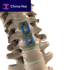 Cervical arthrodesis plate T-6Al-4V ELI lockingmetallic2 levels