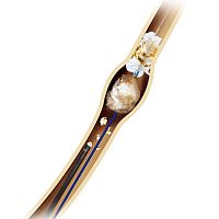 Stone extraction catheter ureteralhydrophilic