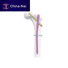 Femoral intramedullary nail trochantermetallic