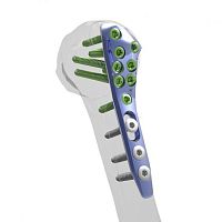 Humerus compression plate Aliansproximallockingmetallic