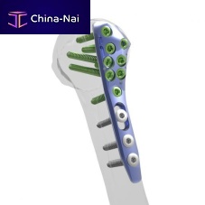 Humerus compression plate Aliansproximallockingmetallic