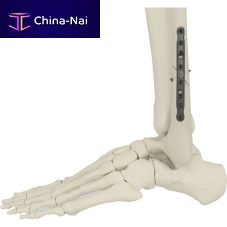Fibula osteotomy plate PK-SFP seriesmid-shaftnon-lockingmetallic