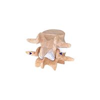 Lumbar interspinous vertebral implant IntraSPINE®
