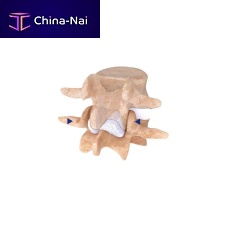 Lumbar interspinous vertebral implant IntraSPINE®