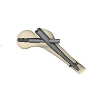 Femoral intramedullary nail Gamma3trochanterproximal fixationtitanium