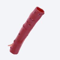 Pulmonary artery vascular bioprosthesis CryoGraft® allograftwith valve