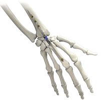 Wrist intramedullary nail IMPLATE ®