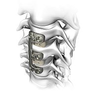 Cervical arthrodesis plate VERTEVIEWlockingmetallic2 levels