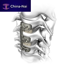 Cervical arthrodesis plate VERTEVIEWlockingmetallic2 levels
