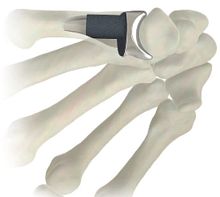 Metacarpophalangeal joint implant STABLYX ®