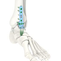 Ankle arthrodesis plate ARIX 3.5medialdistallocking