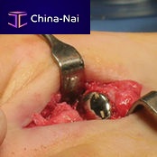 Interphalangeal foot joint implant HemiCAP DF®