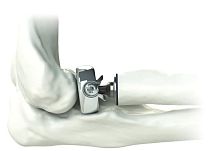 Radial head prosthesis ALIGN ®