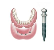 Tapered dental implant ATLAS titaniumexternalone-stage