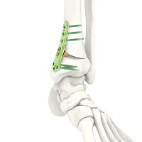 Tibia osteotomy plate ARIX 3.5distallockingtitanium