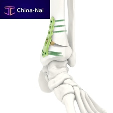 Tibia osteotomy plate ARIX 3.5distallockingtitanium