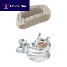 Lumbo-sacral interbody fusion cage pezolateralPEEK
