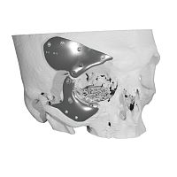 Maxillofacial compression plate Custom-made implantmetallic