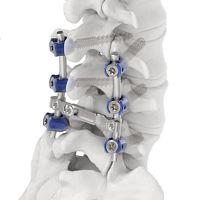 Lumbar osteosynthesis unit posterioradult