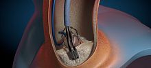 Atherectomy catheter GEMINI aortic