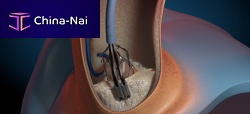 Atherectomy catheter GEMINI aortic