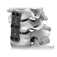 Cervical arthrodesis plate GRUVElockingmetallic2 levels
