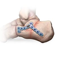 Calcaneus compression plate