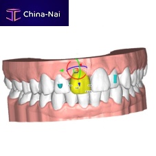 Dental laboratory software ALIGNERorthodonticfor dental officestreatment planning