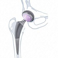 Primary hip prosthesis Excia® Tcemented or non-cemented